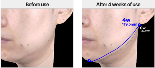 Facial Contour Lifting / Before use / After 4 weeks of use